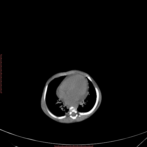 Autosomal recessive polycystic kidney disease associated with Caroli disease (Radiopaedia 61932-69984 Axial non-contrast 74).jpg