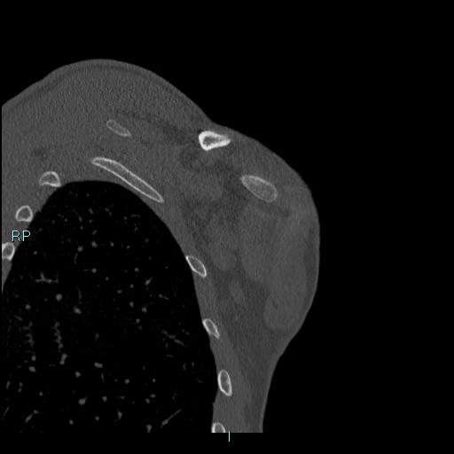 Avascular necrosis after fracture dislocations of the proximal humerus (Radiopaedia 88078-104655 Coronal bone window 114).jpg