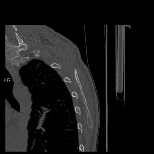 Avascular necrosis after fracture dislocations of the proximal humerus (Radiopaedia 88078-104655 Sagittal bone window 87).jpg