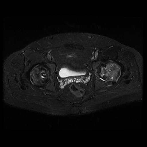 File:Avascular necrosis of the hip (Radiopaedia 61503-69465 Axial STIR 16).jpg