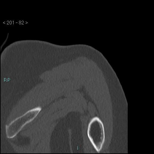 Avascular necrosis of the shoulder - Cruess stage I (Radiopaedia 77674-89887 Coronal bone window 81).jpg