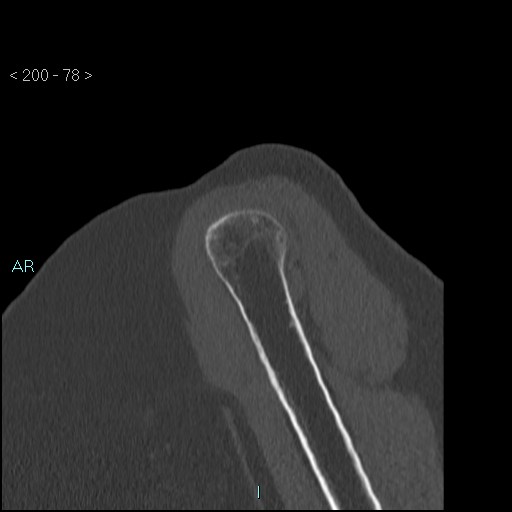 Avascular necrosis of the shoulder - Cruess stage I (Radiopaedia 77674-89887 Sagittal bone window 77).jpg