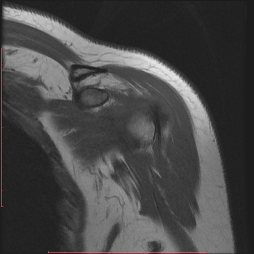 File:Avulsion fracture - greater tuberosity of humerus (Radiopaedia 25457-25703 Coronal T1 3).jpg