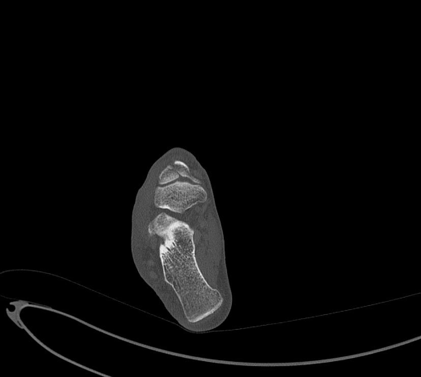 Avulsion fractures of talus and calcaneus (Radiopaedia 48277-53155 Axial bone window 66).jpg
