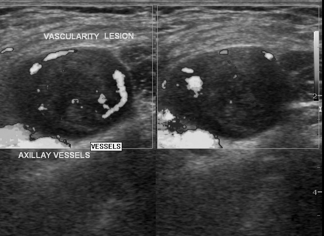 File:Axillary nerve sheath tumor (Radiopaedia 12201-12526 C 1).jpg