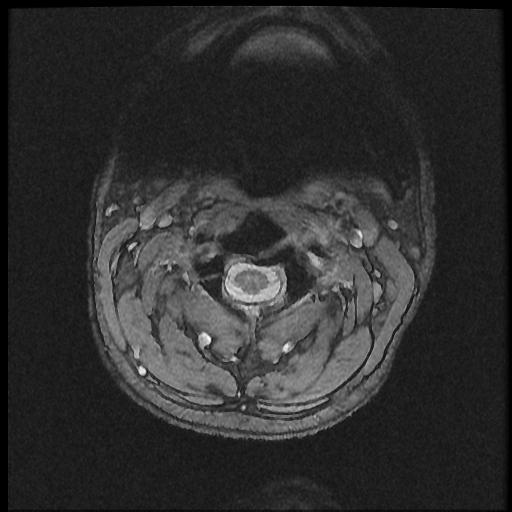 File:Axis fracture - MRI (Radiopaedia 71925-82375 Axial T2 fat sat 4).jpg