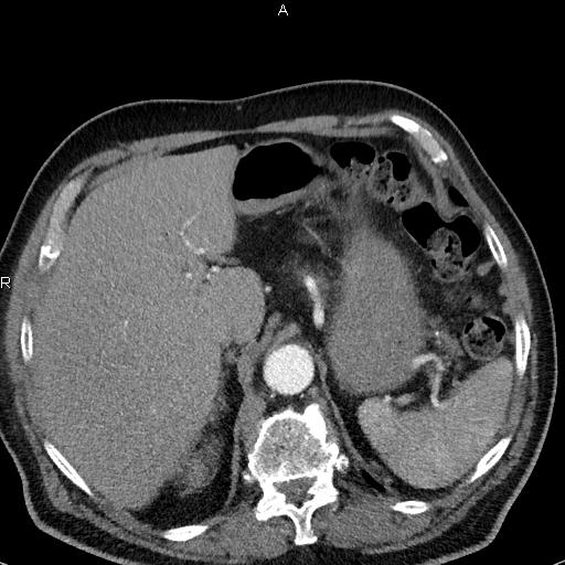 File:Azygos continuation of the inferior vena cava (Radiopaedia 18537-18404 C+ arterial phase 54).jpg
