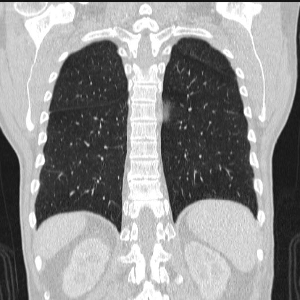 Azygos lobe (Radiopaedia 38259-40275 Coronal lung window 61).jpg