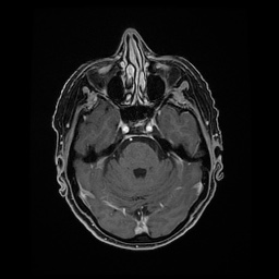 Balo concentric sclerosis (Radiopaedia 53875-59982 Axial LAVA C+ 82).jpg