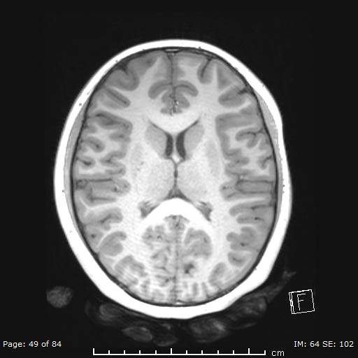 File:Balo concentric sclerosis (Radiopaedia 61637-69636 Axial T1 49).jpg