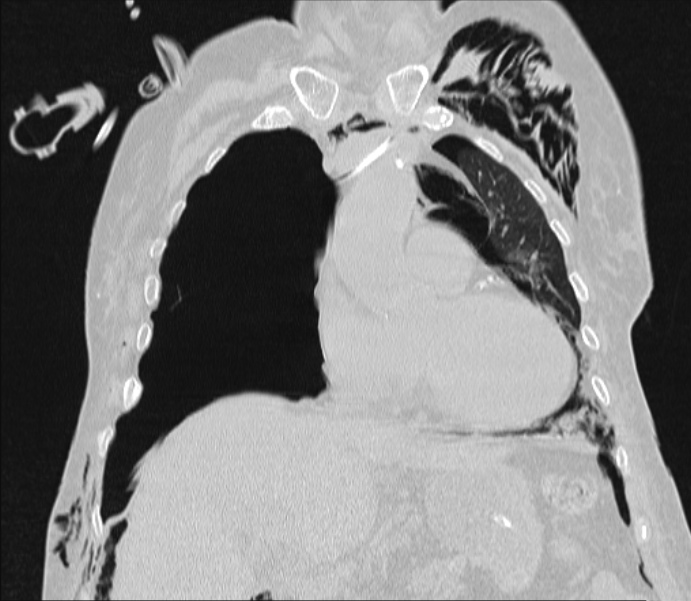 Barotrauma due to mechanical ventilation (Radiopaedia 28079-28336 Coronal lung window 39).jpg