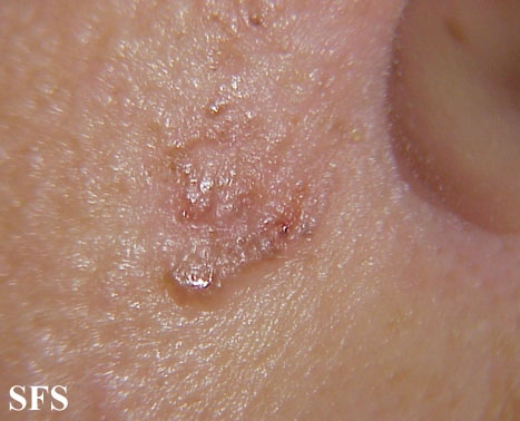 Basal Cell Carcinoma (Dermatology Atlas 54).jpg