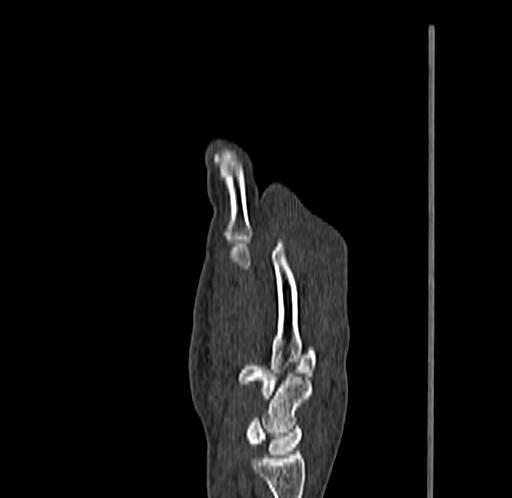 Base of 2nd metacarpal fracture (Radiopaedia 73741-84544 Sagittal bone window 41).jpg