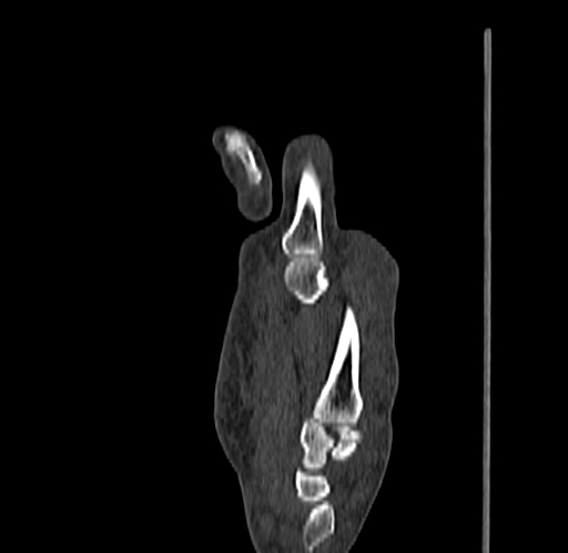 Base of 2nd metacarpal fracture (Radiopaedia 73741-84544 Sagittal bone window 48).jpg