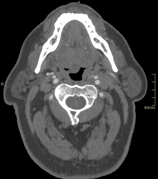 Basilar artery aneurysm (Radiopaedia 56261-62932 A 16).jpg