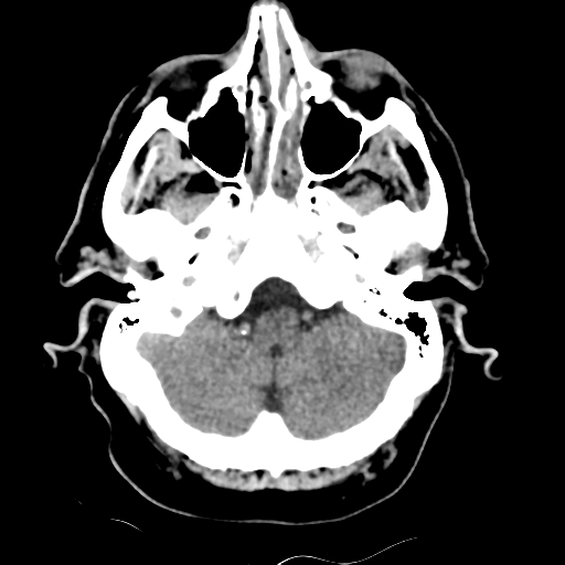 File:Basilar artery occlusion (Radiopaedia 33570-34659 Axial non-contrast 9).png
