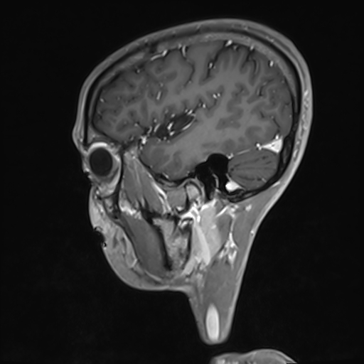 File:Basilar artery perforator aneurysm (Radiopaedia 82455-97733 G 34).jpg