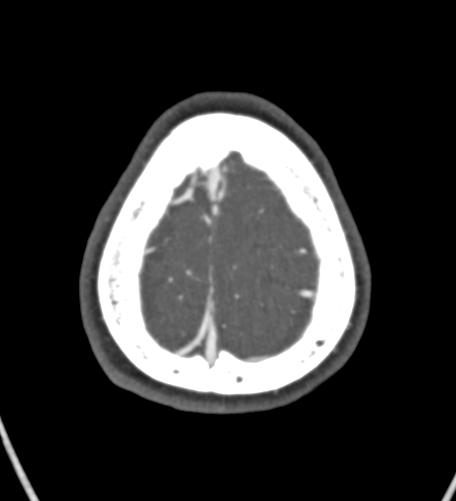 Basilar tip aneurysm with coiling (Radiopaedia 53912-60086 A 136).jpg