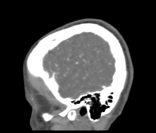 File:Basilar tip aneurysm with coiling (Radiopaedia 53912-60086 C 121).jpg