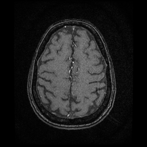 Basilar top and left middle cerebral artery aneurysm (Radiopaedia 61965-70031 Axial MRA 135).jpg
