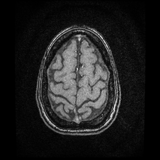 Basilar top and left middle cerebral artery aneurysm (Radiopaedia 61965-70031 Axial MRA 151).jpg