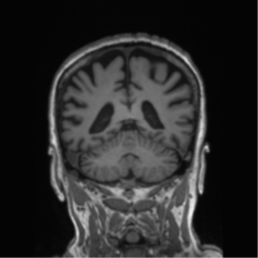 Behavioral variant frontotemporal dementia and late onset schizophrenia (Radiopaedia 52197-58083 Coronal T1 35).png