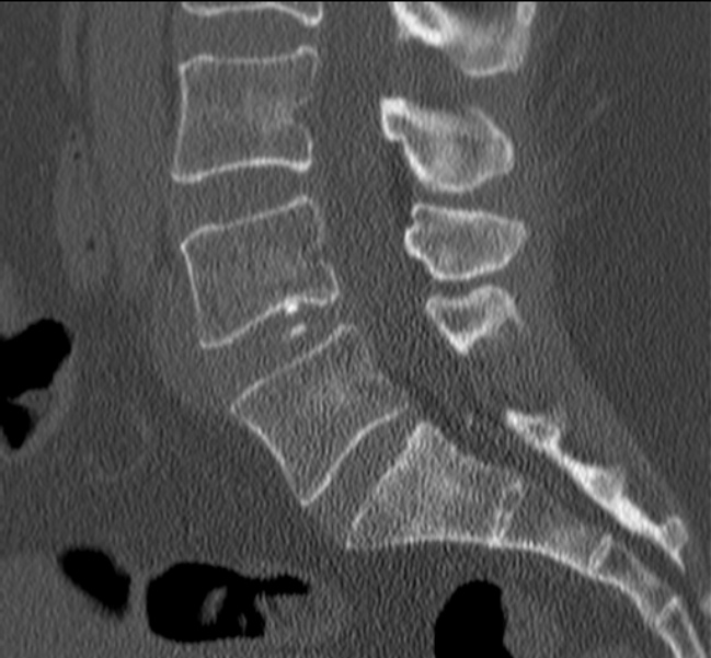 Bertolotti syndrome (Radiopaedia 24864-25128 Sagittal bone window 28).jpg