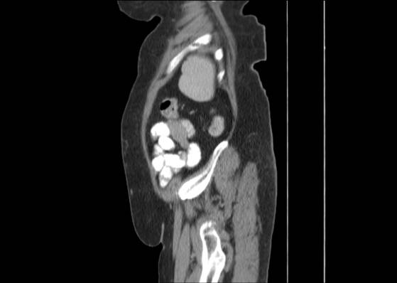 File:Bicameral celiacomesenteric aneurysm (Radiopaedia 55766-62327 B 49).jpg