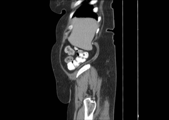 Bicameral celiacomesenteric aneurysm (Radiopaedia 55766-62327 B 9).jpg