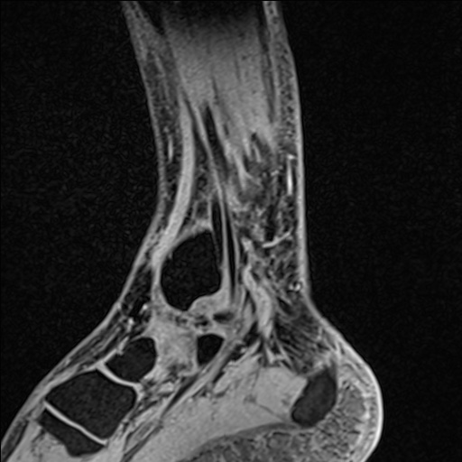 Bilateral Achilles tendon complete tear (Radiopaedia 81344-95051 Sagittal WE - Left 37).jpg