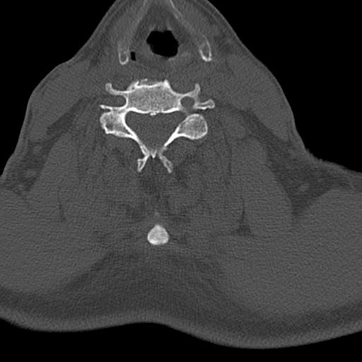 File:Bilateral C6-7 locked facet dislocation (Radiopaedia 28506-28748 Axial bone window 16).jpeg