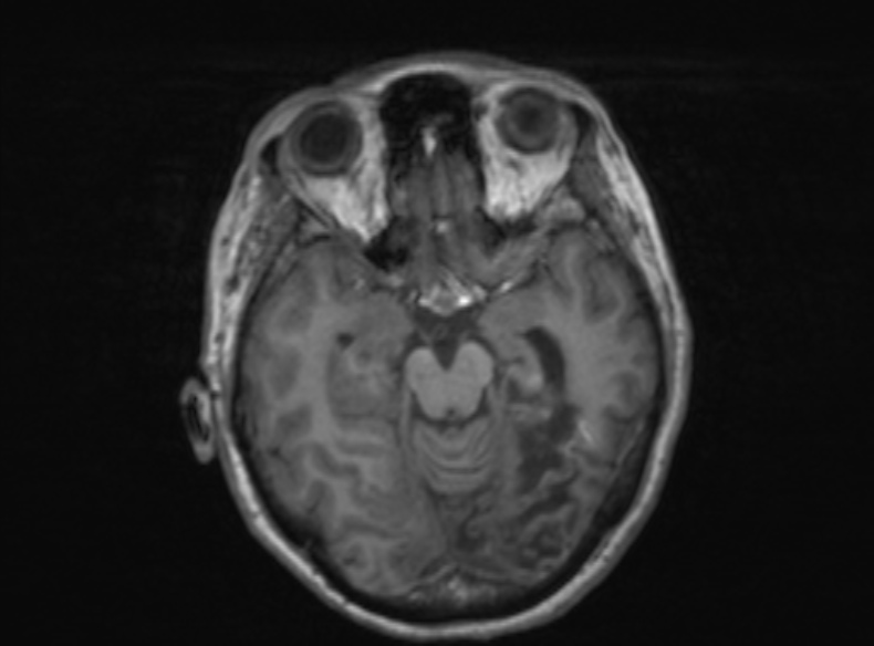 Bilateral PCA territory infarction - different ages (Radiopaedia 46200-51784 Axial T1 270).jpg