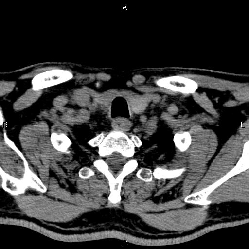 Bilateral Warthin tumors (Radiopaedia 84034-99263 Axial non-contrast 58).jpg