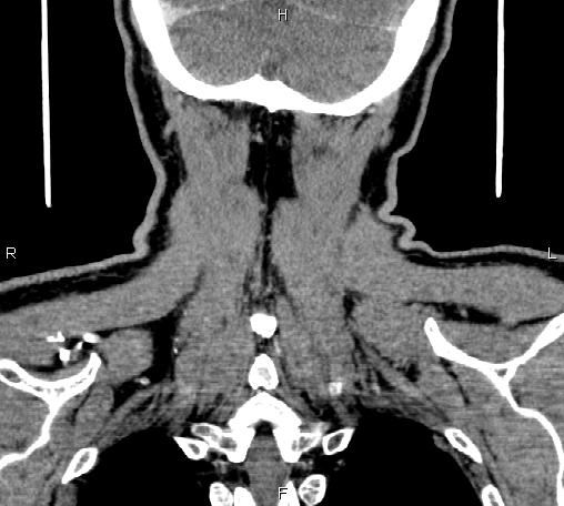 File:Bilateral Warthin tumors (Radiopaedia 84034-99263 C 48).jpg