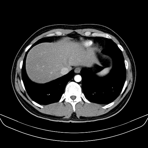 Bilateral accessory renal arteries with mild pelvi-ureteric junction (PUJ) obstruction (Radiopaedia 66357-75596 A 1).jpg
