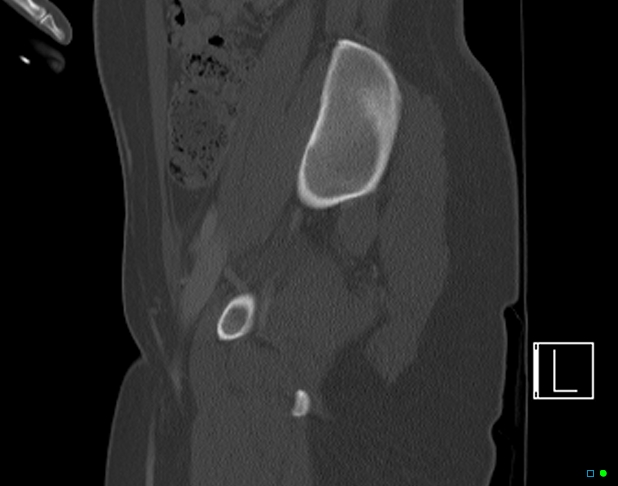 Bilateral acetabular fractures (Radiopaedia 79272-92308 Sagittal bone window 28).jpg