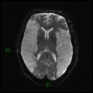 File:Bilateral acute middle cerebral artery territory infarcts (Radiopaedia 77319-89402 Axial DWI 13).jpg