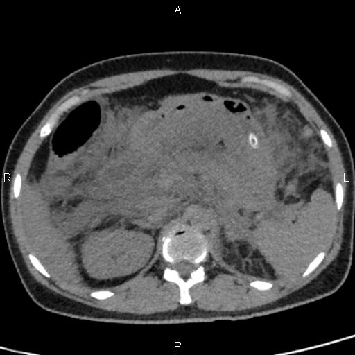 Bilateral adrenal gland hyperenhancement in pancreatitis (Radiopaedia 86642-102753 Axial non-contrast 36).jpg