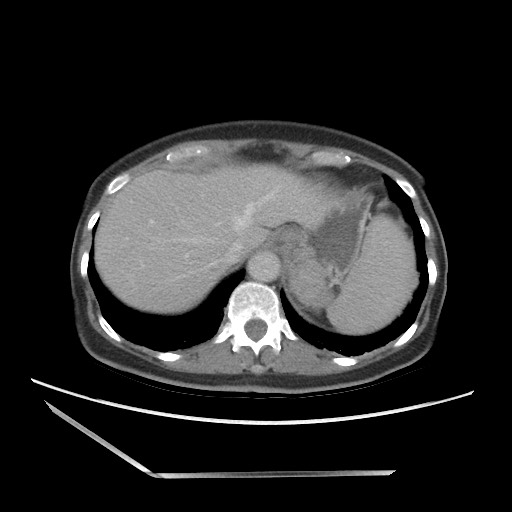 File:Bilateral adrenal granulocytic sarcomas (chloromas) (Radiopaedia 78375-91007 A 22).jpg