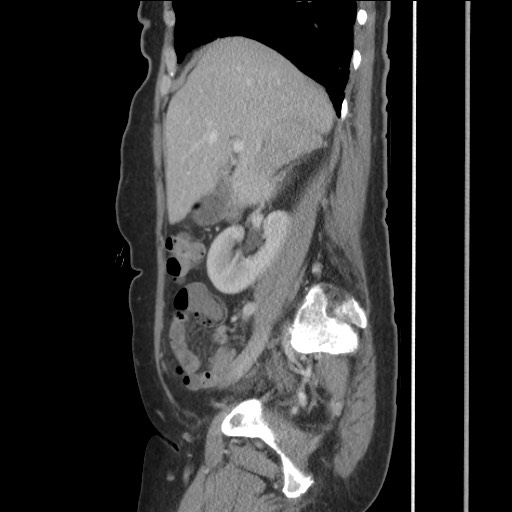 Bilateral adrenal granulocytic sarcomas (chloromas) (Radiopaedia 78375-91007 C 54).jpg