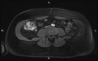 Bilateral adrenal myelolipoma (Radiopaedia 63058-71537 Axial T1 C+ fat sat 71).jpg
