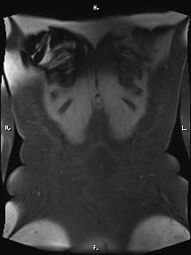 Bilateral adrenal myelolipoma (Radiopaedia 63058-71537 Coronal T1 fat sat 7).jpg