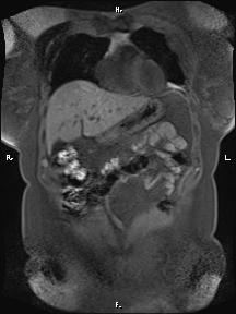 File:Bilateral adrenal myelolipoma (Radiopaedia 63058-71537 Coronal T1 fat sat 82).jpg