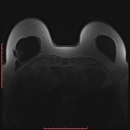 File:Bilateral breast implant rupture (Radiopaedia 24761-25027 PASTA 23).jpg