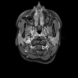 File:Bilateral carotid body tumors and right jugular paraganglioma (Radiopaedia 20024-20060 Axial 106).jpg