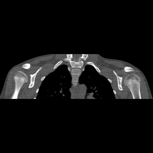Bilateral chronic posterior shoulder dislocation (Radiopaedia 39213-41452 Coronal bone window 33).jpg