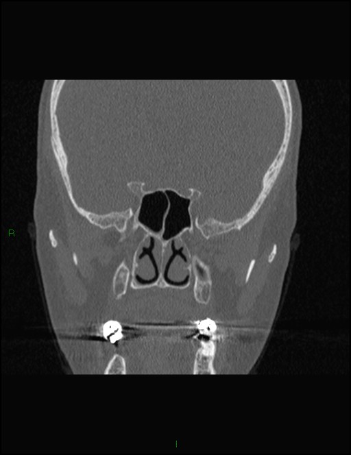 Bilateral frontal mucoceles (Radiopaedia 82352-96454 Coronal 198).jpg