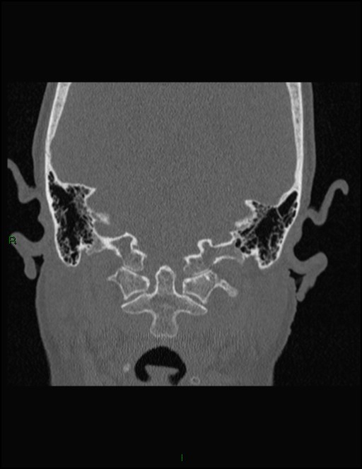 Bilateral frontal mucoceles (Radiopaedia 82352-96454 Coronal 338).jpg