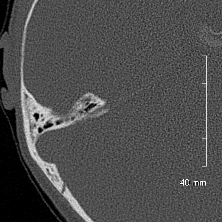 Bilateral grommets (Radiopaedia 47710-52404 Axial bone window 62).jpg