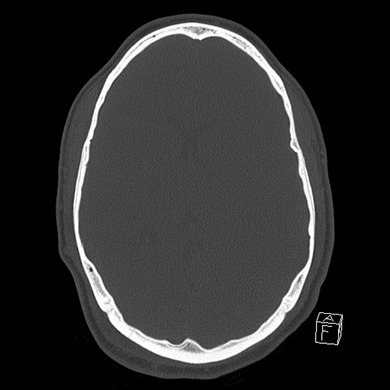 Bilateral occipital condyle fracture (type 2) (Radiopaedia 87675-104089 Axial bone window 69).jpg